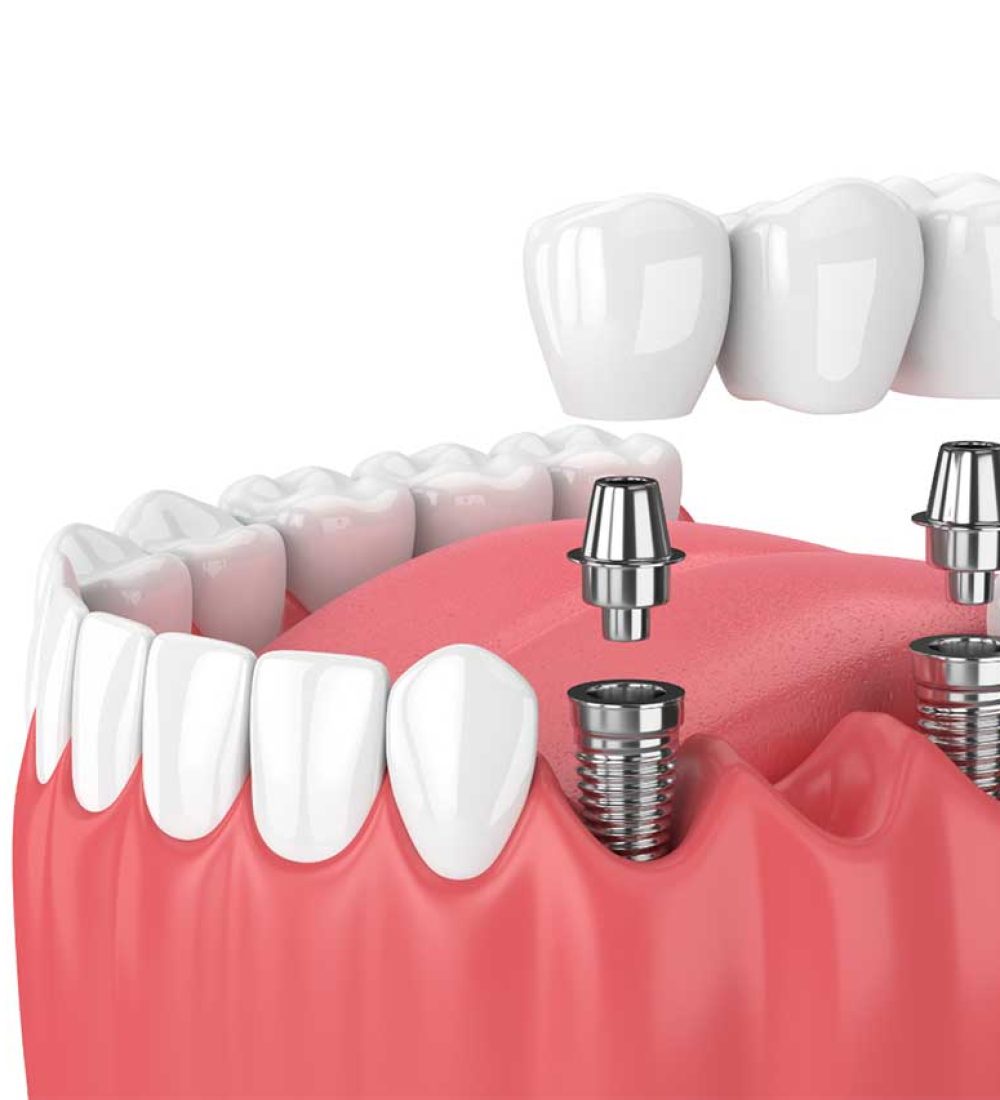 dental-implants-dubai-2.jpg